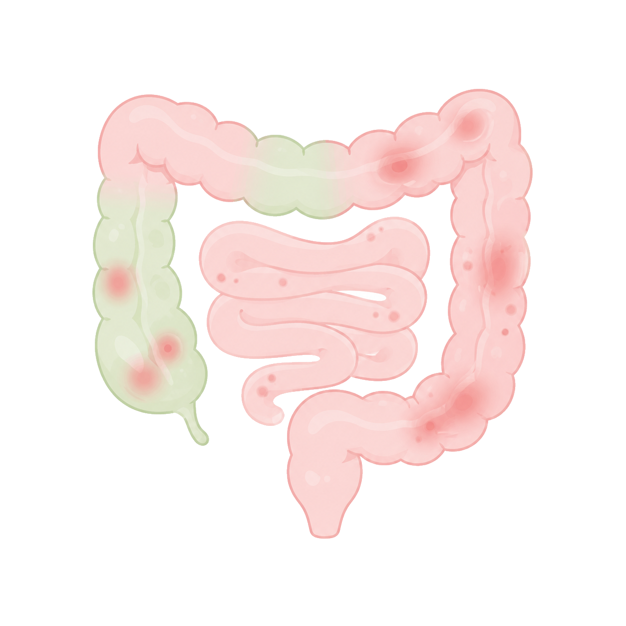 腸の病気のイラスト