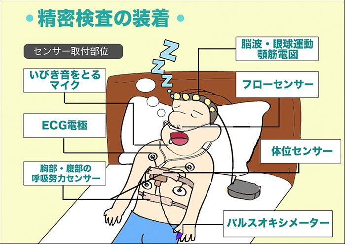 小児の睡眠時無呼吸症候群の診断