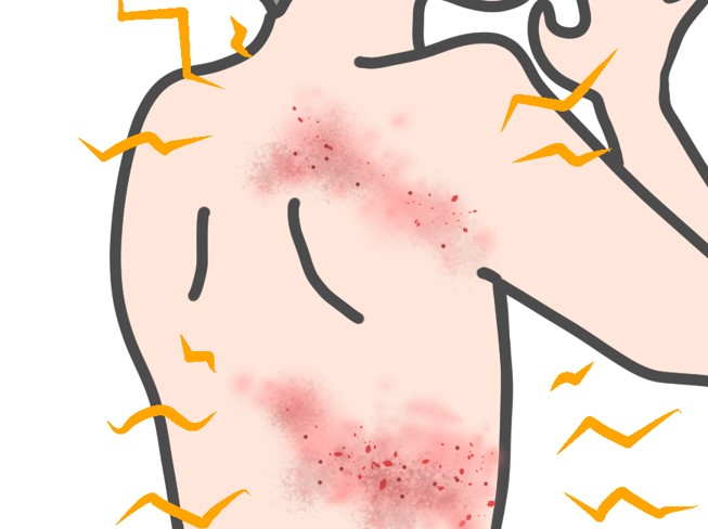 帯状疱疹の予防について（予防接種・ワクチン）｜シングリックス・乾燥弱毒水痘生ワクチン｜広島市安佐南区の内科なら西原セントラルクリニック