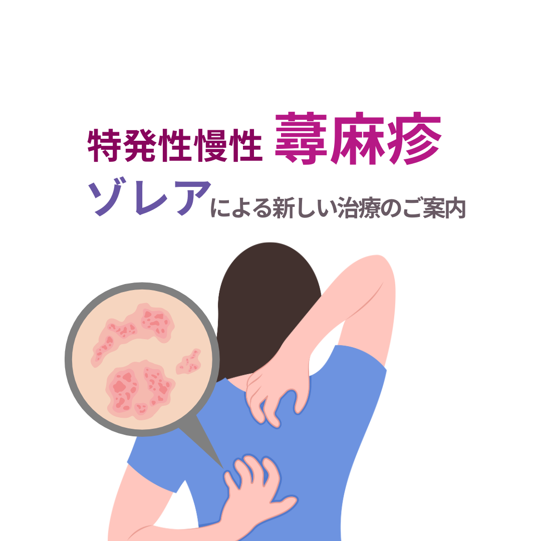 特発性慢性蕁麻疹に対する新たな治療法 ― ゾレア（オマリズマブ）をご存じですか？