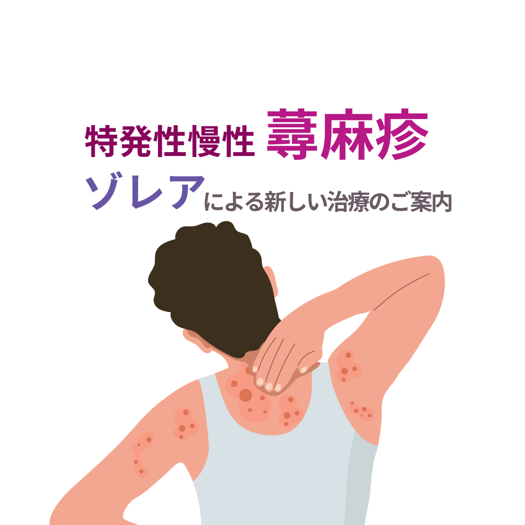 特発性慢性蕁麻疹にお悩みの方へ―ゾレア（オマリズマブ）による新しい治療のご案内