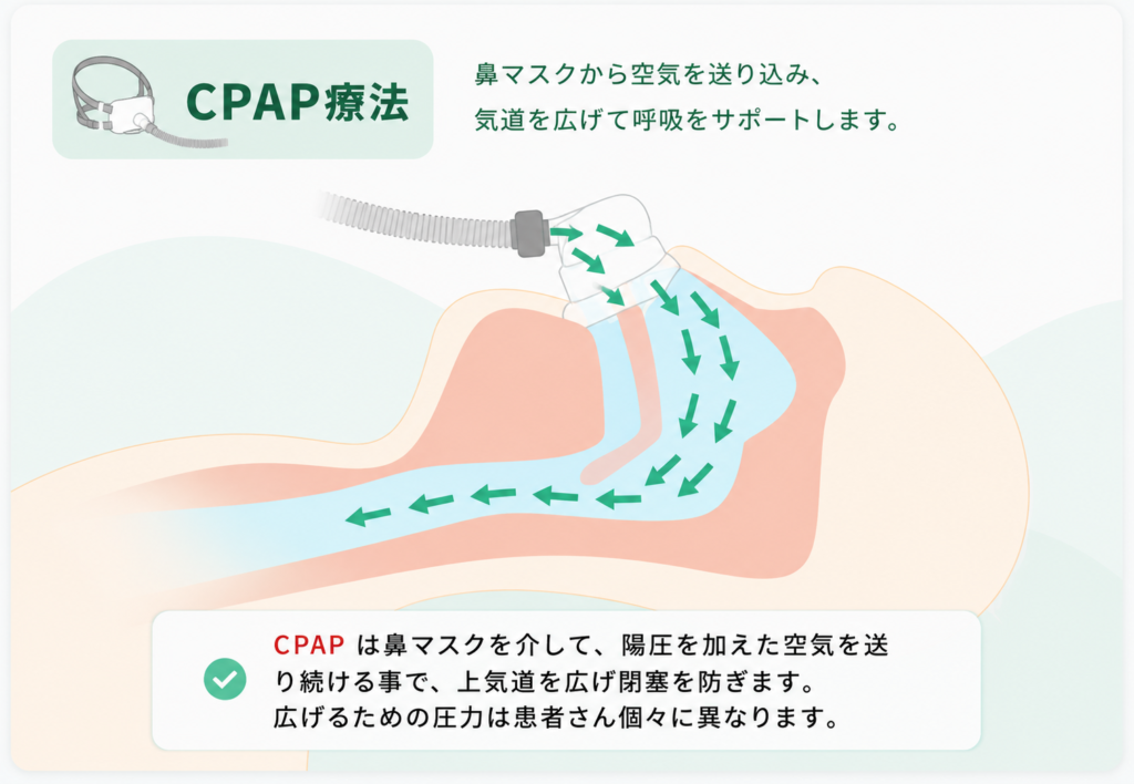CPAPは鼻マスクを介して空気を送り続けることで、上気道を広げ閉塞を防ぎます|下山記念クリニック(東広島市)