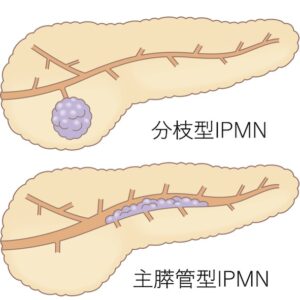 膵嚢胞　分枝型IPMNと主膵管型IPMN