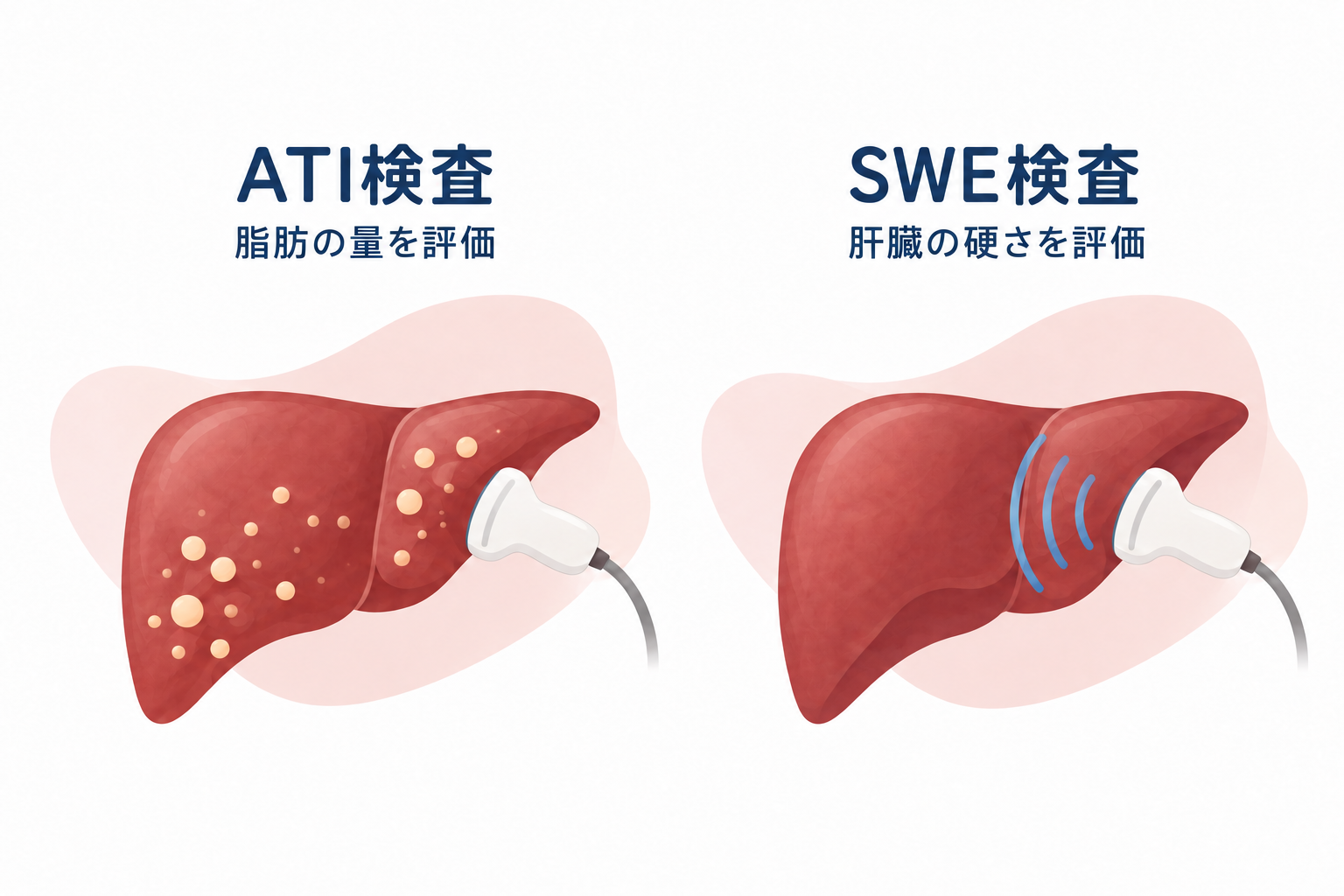 ATI検査は肝臓の脂肪の量を、SWE検査は肝臓の硬さを評価する検査です